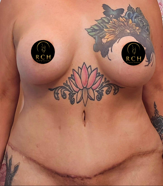 Mommy Makeover results in Tyler TX