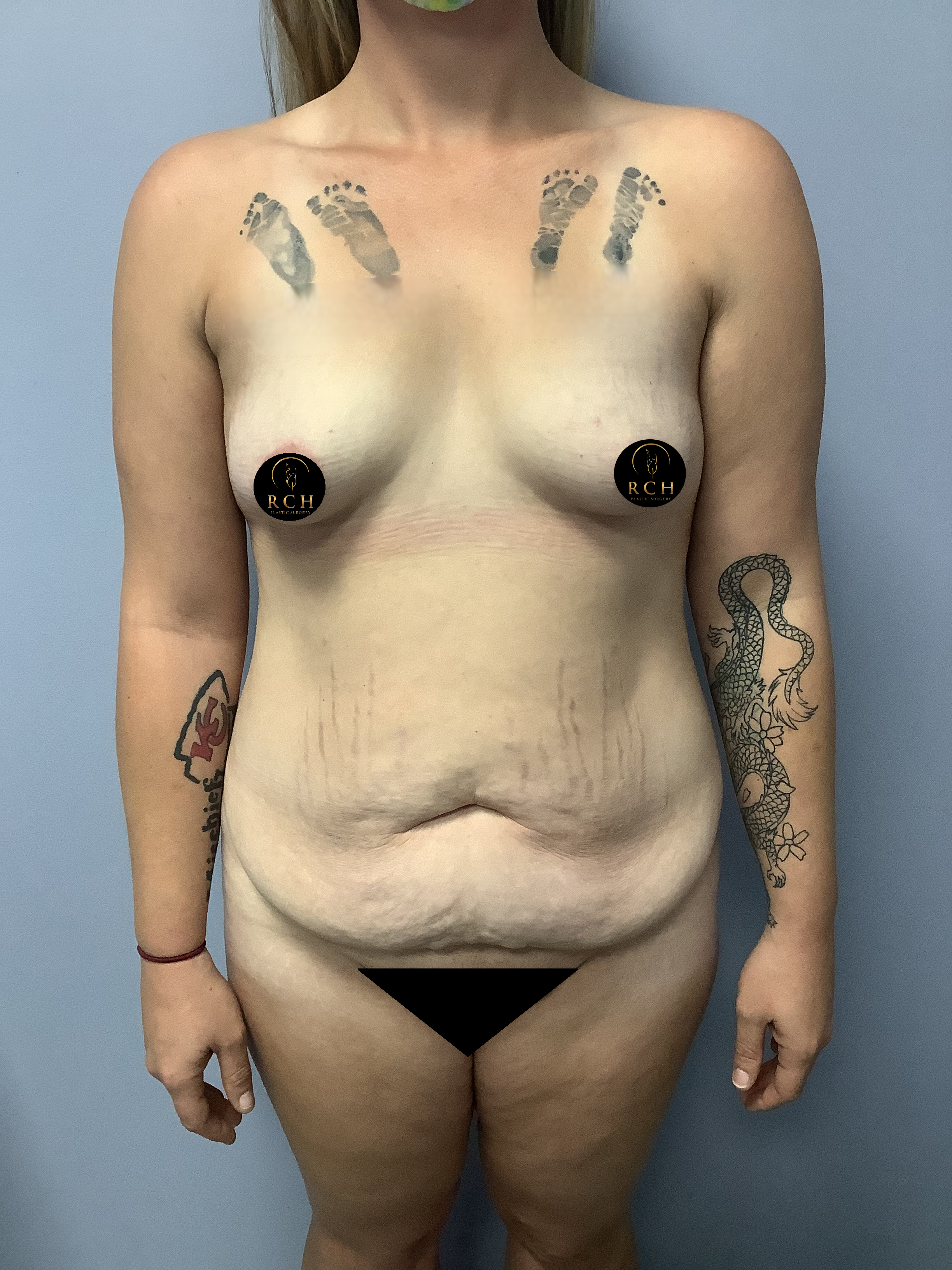 Mommy Makeover pictures in Tyler TX