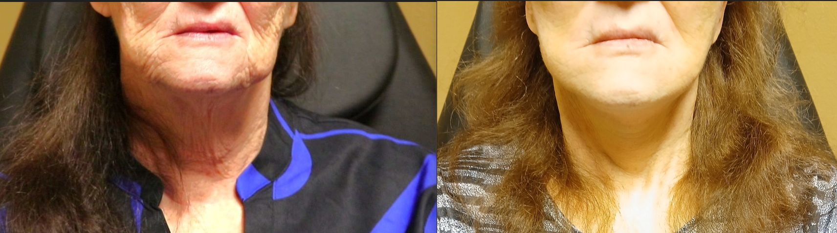 Neck lift results in Tyler TX