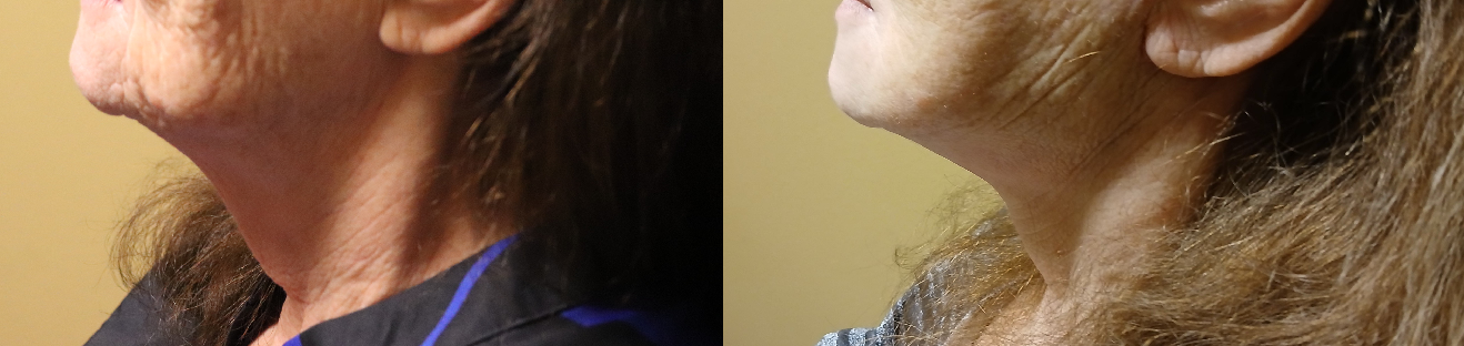 Mommy Makeover pictures in Tyler TX