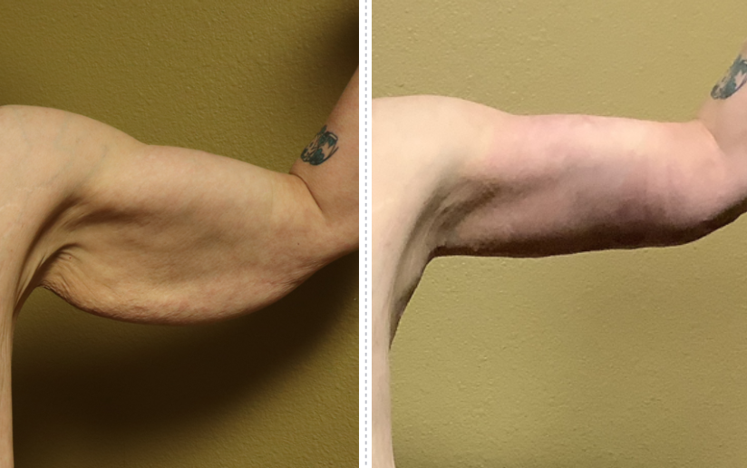 arm lift surgery before and after