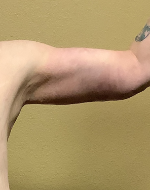 After arm lift left arm