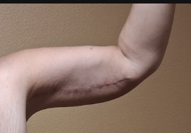 After arm lift left arm