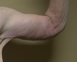 After arm lift left arm