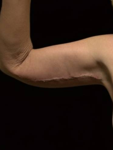 After arm lift right arm