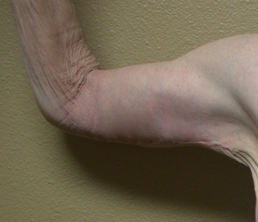 After arm lift right arm