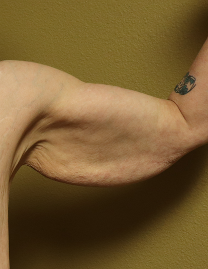 Before arm lift left arm