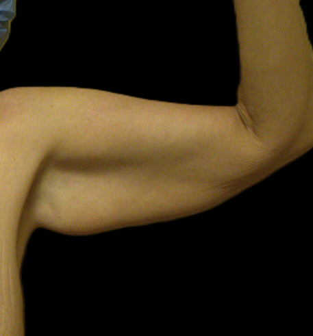 Before arm lift left arm