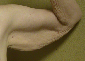 Before arm lift left arm