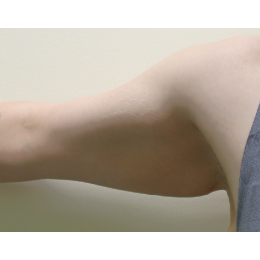 Before arm lift right arm