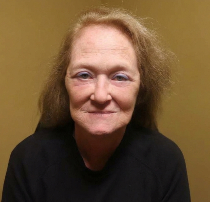 After face lift front view