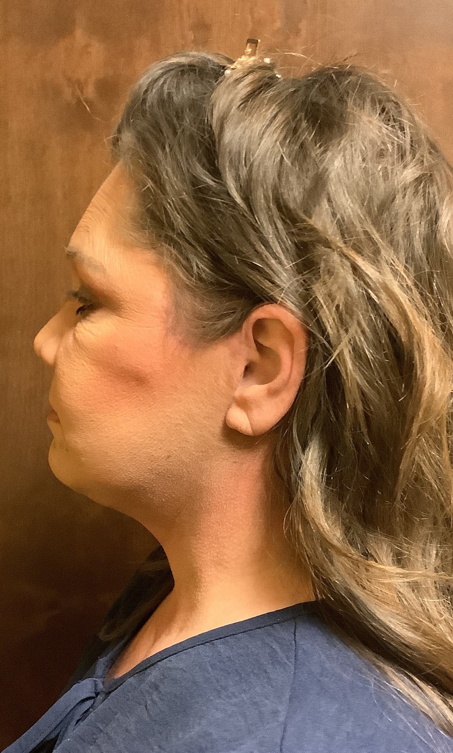 After face lift side