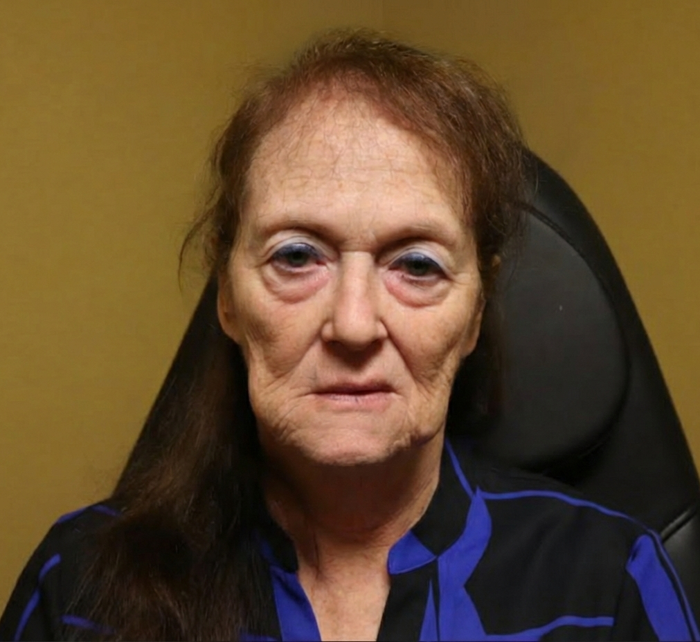 Before facelift front view