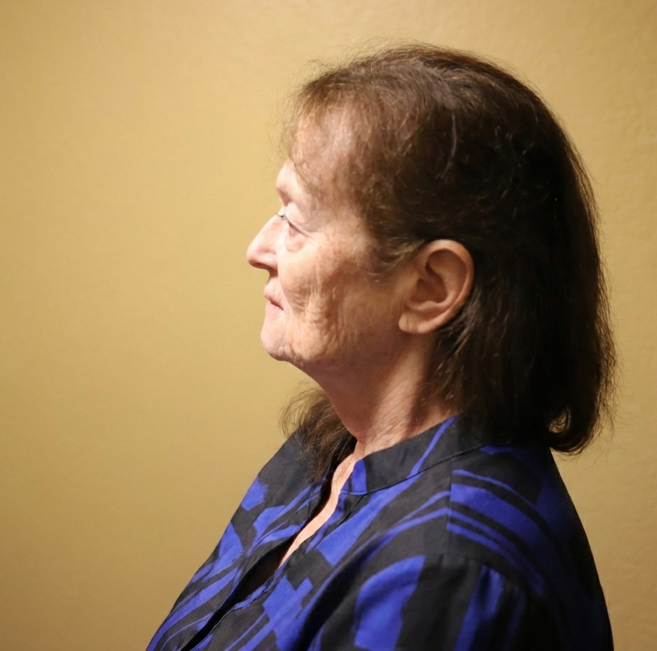 Before facelift side view