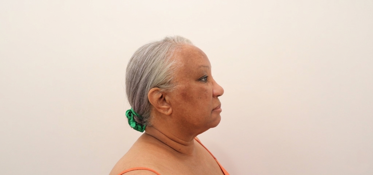 Photo Before facelift side view