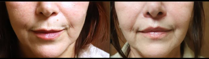 Before and after photos of a lip lift patient, close-up of the nose, lips and lower face